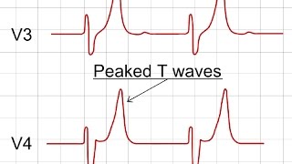 Hyperkalemia on ECG  ECG Findings of Hyperkalemia [upl. by Suoivatnod]