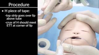 quotSecuring Oral and Nasal Endotracheal Tubesquot by Craig Smallwood RRT for OPENPediatrics [upl. by Sherr]