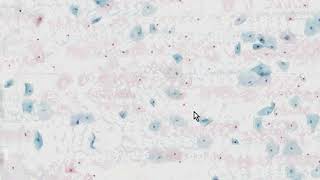 Cervix Low Grade Squamous Intraepithelial Lesion LSIL AutoCyte Histopathology  Madeformedicalcom [upl. by Strohl]