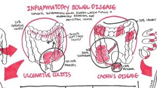 Inflammatory Bowel Disease  Crohns and Ulcerative Colitits [upl. by Alejo]