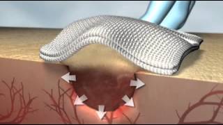 Floseal matriz hemostatica [upl. by Wood683]