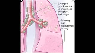 Sarcoidosis Noncaseating Granulomas [upl. by Ellegna760]