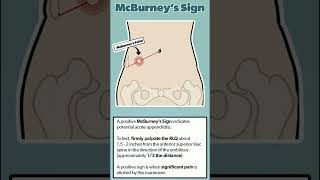 McBurneys Sign In appendix doctor shortsfeed short shortsvideo [upl. by Doehne]