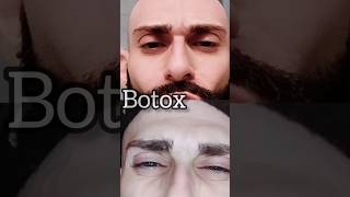 MY Botox day 15 AMAZING RESULTS  dysport [upl. by Htebsle]