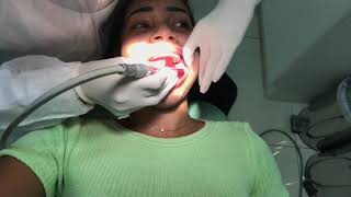 Painful Dental Drilling and Filling on Girl [upl. by Snehpets]