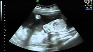 ULTRASONIDO OBSTETRICO [upl. by Anoniw]