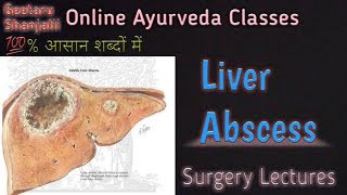 Liver abscess by Geetaru [upl. by Iniretake398]