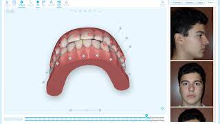 Quick Tip  Bite Correction Visualization in Aligners [upl. by Truscott]