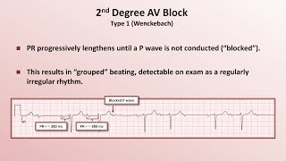 Intro to EKG Interpretation  AV Block [upl. by Ross]