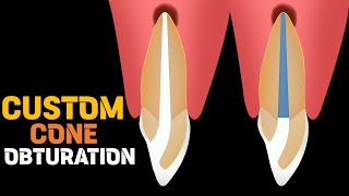 Custom cone obturation [upl. by Bove]