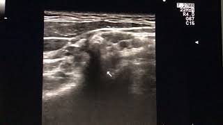 OneMinuteMartinoli video Brachial plexus en Long thoracic nerve [upl. by Airamahs]