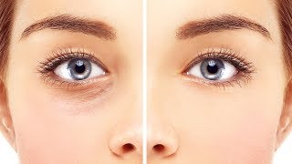 How To GET RID OF DARK CIRCLES and BAGS UNDER EYES Naturally [upl. by Ajna]