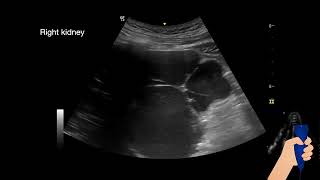 Ultrasound in polycystic kidney disease [upl. by Ynej480]