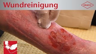 Wundreinigung Debridement bei chronischer Wunde  Verbandswechsel  DRACO [upl. by Saddler607]