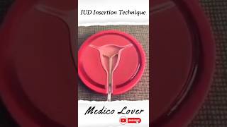 IUD or IUCD is inserted inside the womb [upl. by Neenaej]