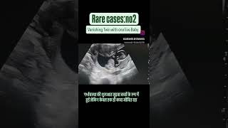 A case of vanishing Twin where the pregnancy started as twin but one baby miscarriedvanishingtwin [upl. by Eade]