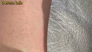 Permanent Hair removal on Candela GentleLASE beforeafter result [upl. by Ilowell]