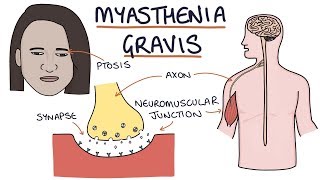 Myasthenia Gravis [upl. by Edina]