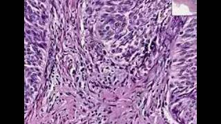 Histopathology Bladder Urothelial carcinoma Grade I [upl. by Verena]