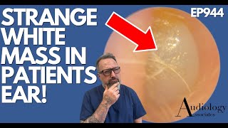 WHAT IS THIS STRANGE WHITE MASS IN PATIENTS EAR  EP944 [upl. by Rolando]