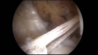 ACL Reconstruction with Single Bundle Hamstring Graft Graftlink [upl. by Zia]