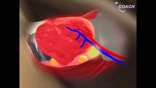 Minimally Invasive Total Thyroidectomy Video [upl. by Stark]