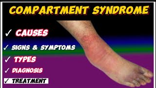 compartment syndrome [upl. by Tneciv60]