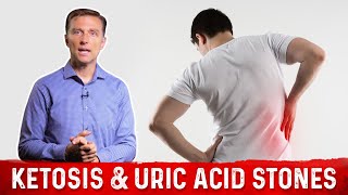 Relation Between Ketosis amp Uric Acid Stones – DrBerg on Keto Kidney Stones [upl. by Enybor]