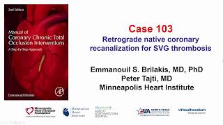 Case 103 Manual of CTO Interventions CTO recanalization for SVG thrombosis [upl. by Sturges]