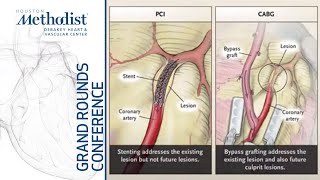 Revascularization for Multivessel Coronary Disease PCI or CABG W F Fearon MD November 18 2021 [upl. by Paugh]