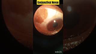 Conjunctival Nevus  Optometry with ShahideyesConjunctivalNevus eyes optometry [upl. by Gee]