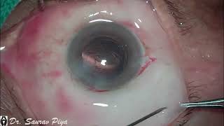 TIPS AND TRICK TO TACKLE CHEMOSIS DURING CATARACT SURGERY  Dr Saurav Piya [upl. by Ahselaf444]