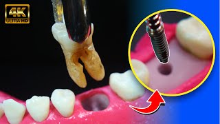 FASINANTE proceso del IMPLANTE dental en 4K [upl. by Atteuqahs607]