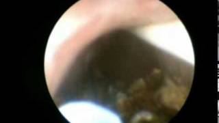 Ureterolitotricia Lasermpg [upl. by Neddra]