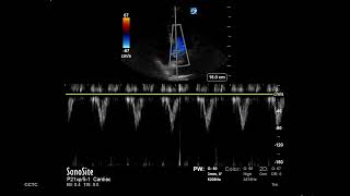 How to Measure LVOT VTI [upl. by Felipa]