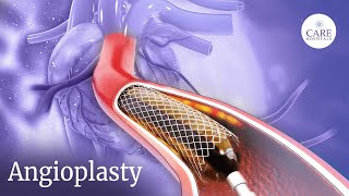 How is Angioplasty Done  Radial Access Procedure  PostTreatment Care After Angioplasty [upl. by Wertheimer]