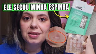 Testei CURATIVO HIDROCOLOIDE PARA ACNE nas minhas Espinhas Marca Needs  Resenha [upl. by Heng951]