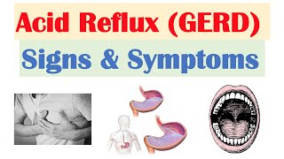 Gastroesophageal Reflux Disease GERD Signs amp Symptoms ex Bad Teeth  amp Why They Occur [upl. by Kries]