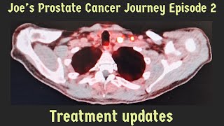 Ep2Prostate Cancer UpdateTreatmentHTSide Effects [upl. by Norvan329]