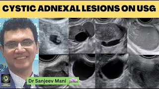 USG Pelvis  Cystic Adnexal Lesions On Ultrasound  SANJEEV MANI  Endometriosis  Ovarian Dermoid [upl. by Ayota]