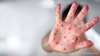 Washington state faces measles outbreak [upl. by Mandy509]