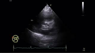 Aortic Stenosis  Transtoracic Echocardiography  Estenose aórtica  Ecocardiografia Transtorácica [upl. by Odine]