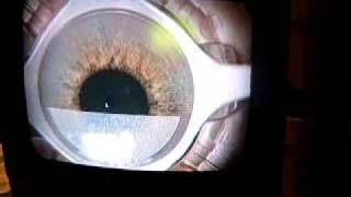 Step by Step Intralasik procedure for Monovision right eye of patient Sandy [upl. by Nylegna]