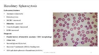 Hindi Hemolytic Anemia membranecytoskeleton defects part 35 Hereditary Spherocytosis [upl. by Eybbob]