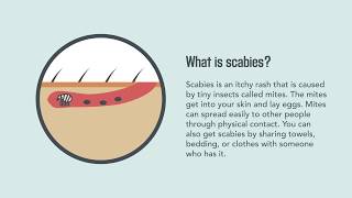 Scabies Signs Symptoms Causes and Treatment  Merck Manual Consumer Version [upl. by Trebornhoj]