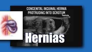 Sonoquickies Hernia [upl. by Lamond974]