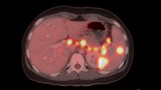 CAR  Case of the Week  CASE 18  Langerhans cell histiocytosis [upl. by Lichtenfeld]