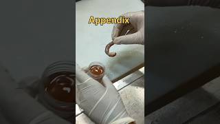 Appendicitis specimen [upl. by Sukramaj228]