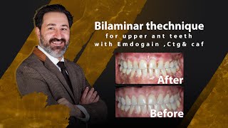 Bilaminar thechnique for upper ant teeth with Emdogain Ctgamp caf  Dr Amirreza Moayer [upl. by Yleoj]