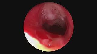 Subglottic stenosis  from injury to repair [upl. by Oznerol]